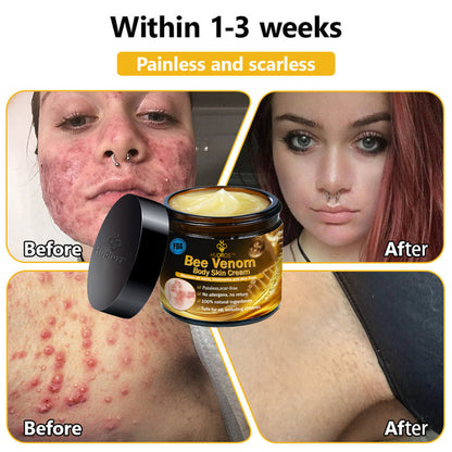 Hudros™ Bee Venom Body Skin Cream（🧑‍⚕️AAD Recommended)🔥