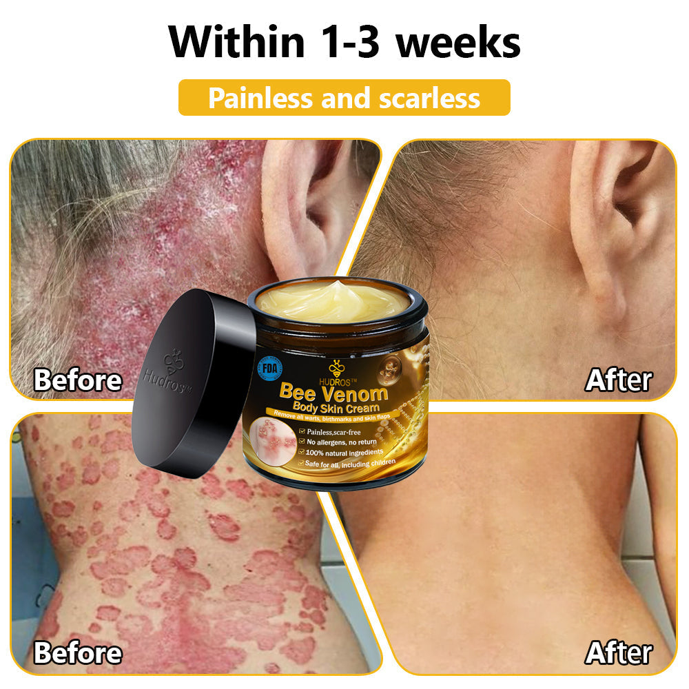 Hudros™ Bee Venom Body Skin Cream（🧑‍⚕️AAD Recommended)🔥