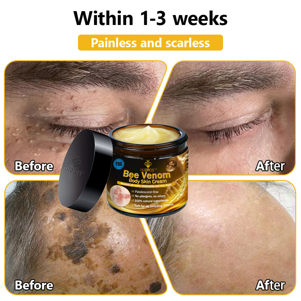 Hudros™ Bee Venom Body Skin Cream（🧑‍⚕️AAD Recommended)🔥