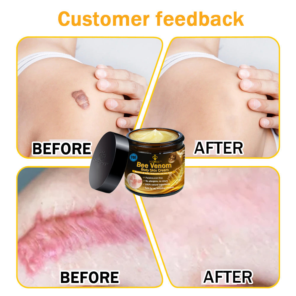 Hudros™ Bee Venom Body Skin Cream（🧑‍⚕️AAD Recommended)🔥